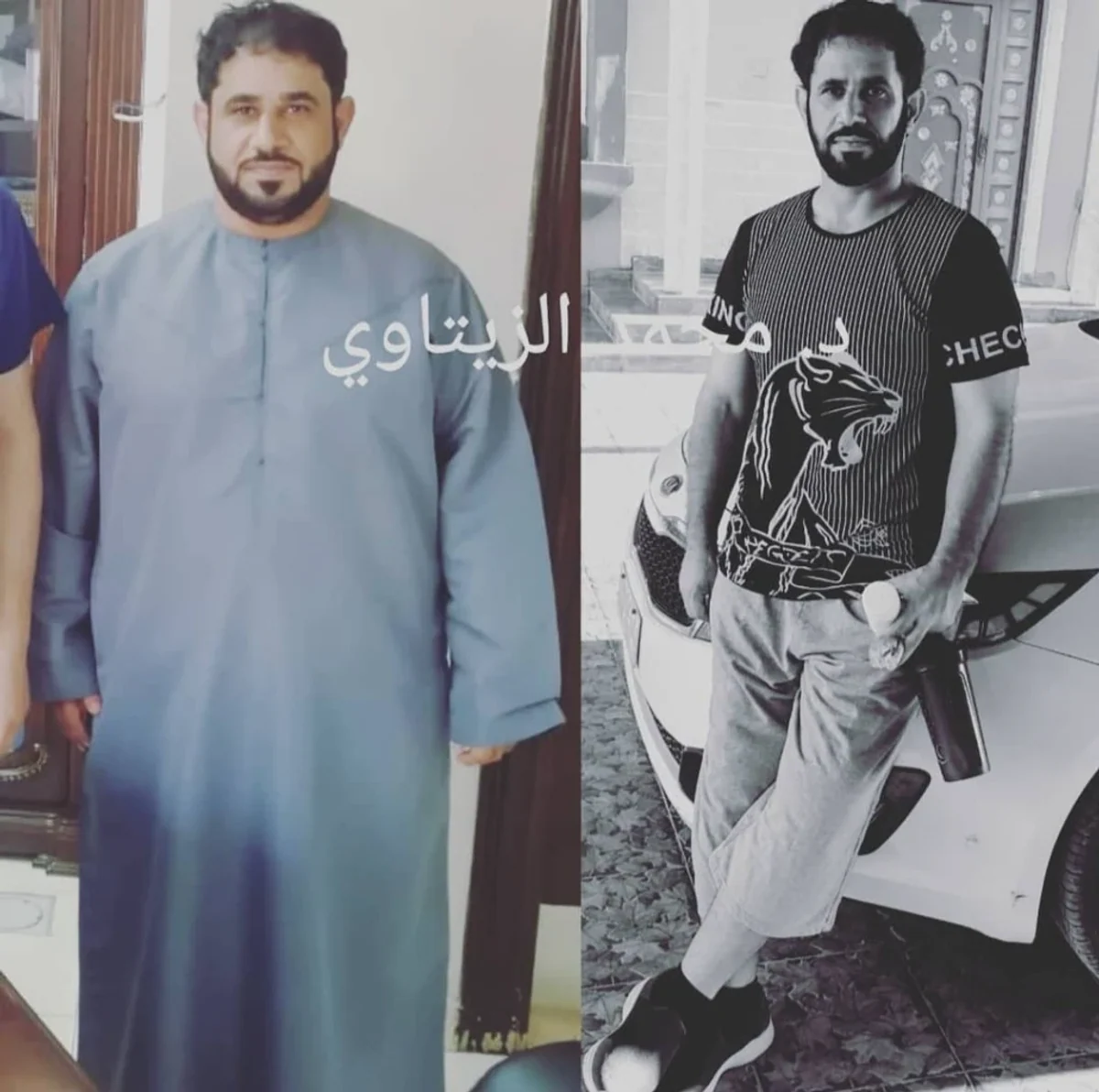 Sleeve gastrectomy and diabetes: 118.5 kg to 77.4 kg | Dr. Mohammad Al-Zaitawi Before and after sleeve gastrectomy: Mohammed Al-Kindi from Oman went from 118.5 kg to 77.4 kg and came off diabetes medication