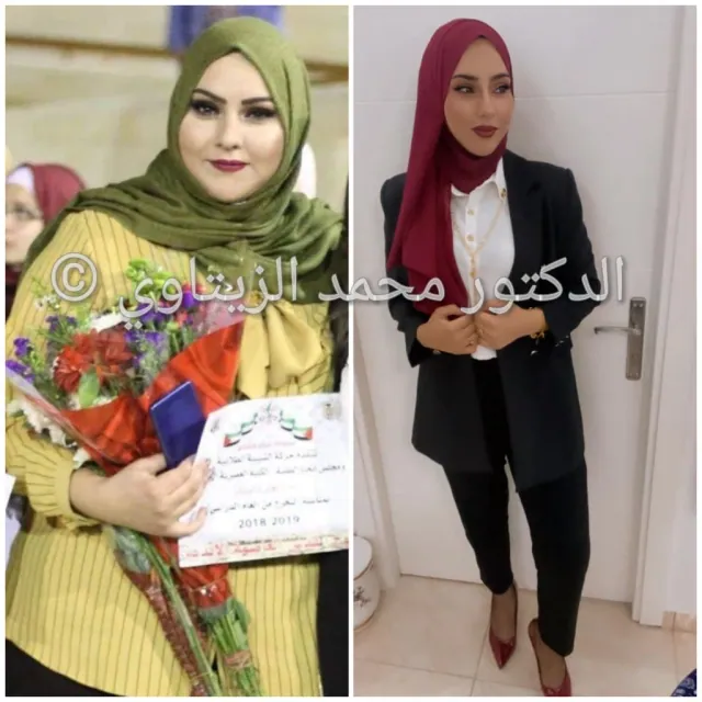 Before and after sleeve gastrectomy: Amal from Palestine went from 112 kg to 70 kg in one year with the gym