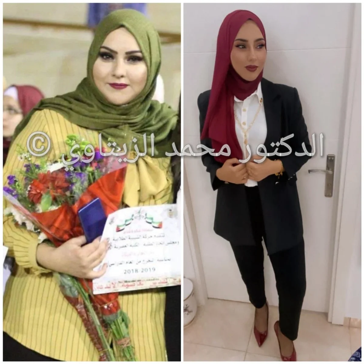 Sleeve gastrectomy and gym: 112 kg to 70 kg | Dr. Mohammad Al-Zaitawi Before and after sleeve gastrectomy: Amal from Palestine went from 112 kg to 70 kg in one year with the gym