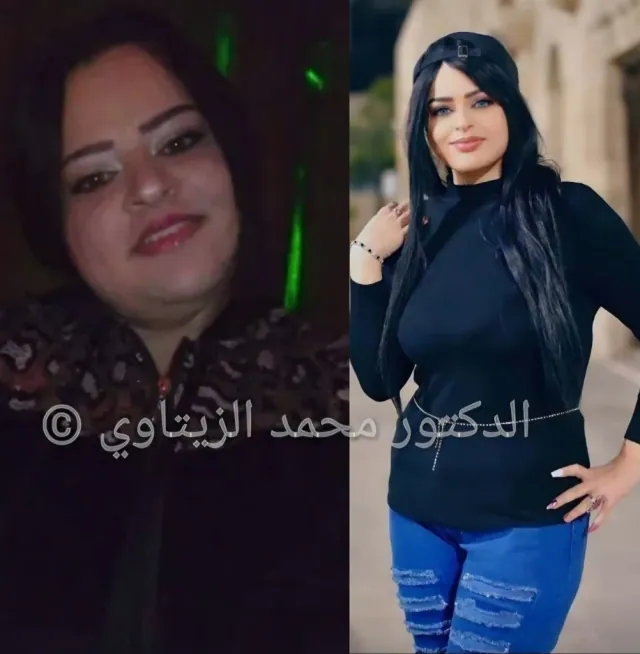 Before and after sleeve gastrectomy: Muneera Al-Qaimari from Palestine went from 140 kg to 69 kg in one year