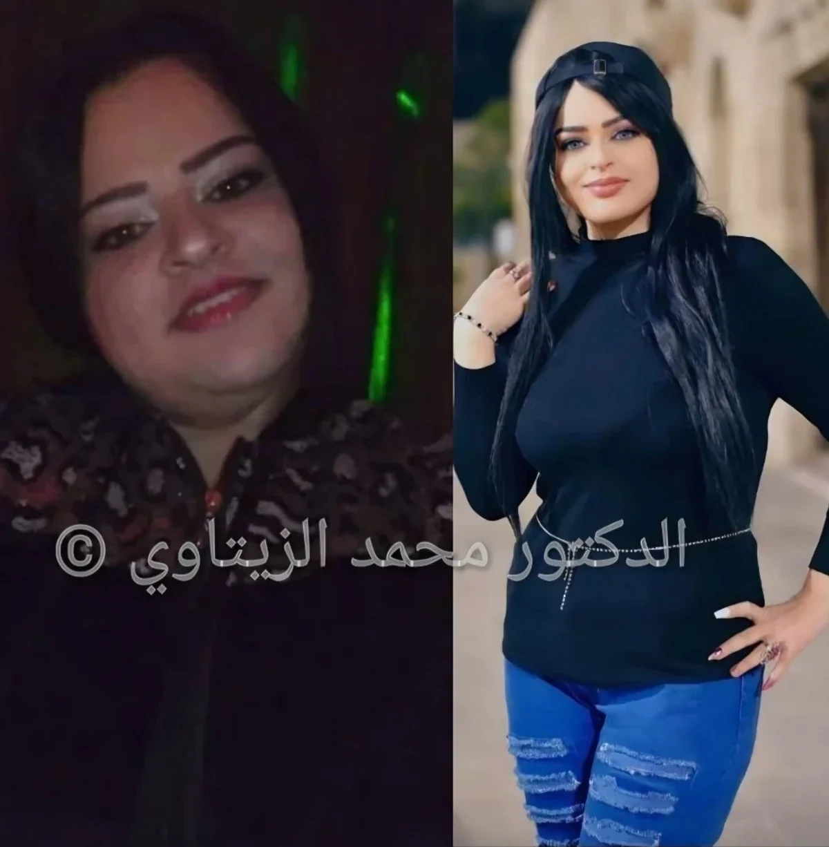 Sleeve gastrectomy and PCOS: 140 kg to 69 kg | Dr. Mohammad Al-Zaitawi Before and after sleeve gastrectomy: Muneera Al-Qaimari from Palestine went from 140 kg to 69 kg in one year