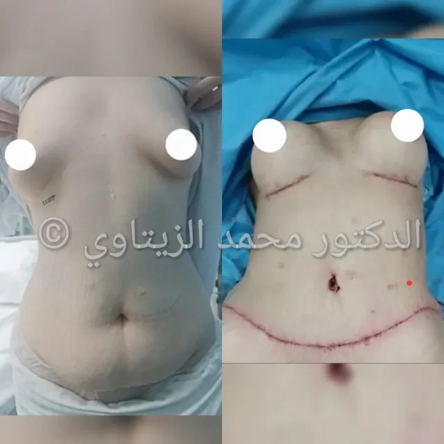 Tummy tuck with breast augmentation before and after | Dr. Mohammad Al-Zaitawi Before and after tummy tuck with breast augmentation: excess abdominal skin removed, waist sculpted and silicone implants placed