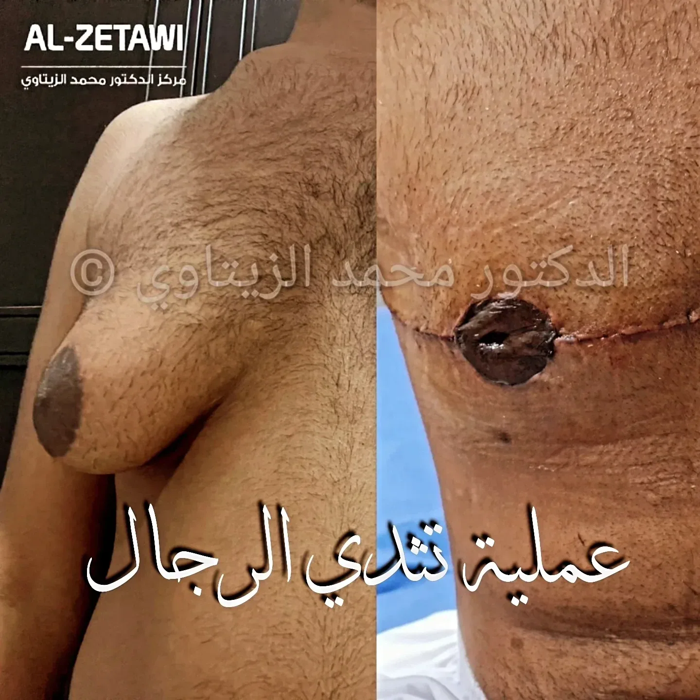 صورة قبل وبعد عملية تثدي الرجال في الأردن — نتيجة حقيقية في مركز الدكتور محمد عبد الوهاب الزيتاوي مع د. محمد عبد الوهاب الزيتاوي