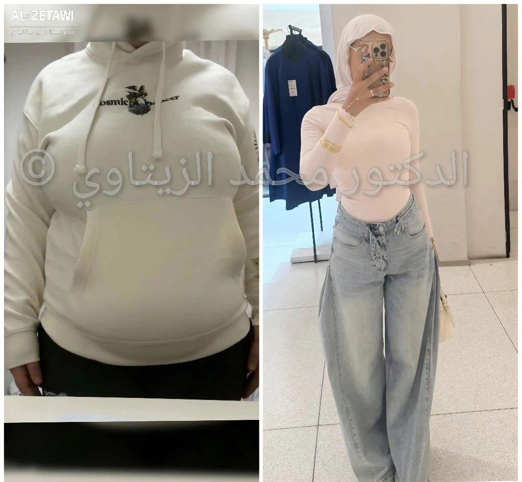 صورة قبل وبعد عملية تحويل المسار المصغر للشابة مجد من فلسطين: من 89 إلى 55 كيلو ومن مقاس XL إلى XS — مركز الدكتور محمد عبد الوهاب الزيتاوي