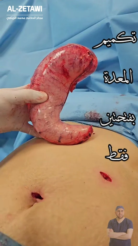الجزء المستأصل من المعدة فوق بطن المريض بجانب فتحتين صغيرتين فقط بعد تكميم المعدة بالمنظار — مركز الدكتور محمد عبد الوهاب الزيتاوي