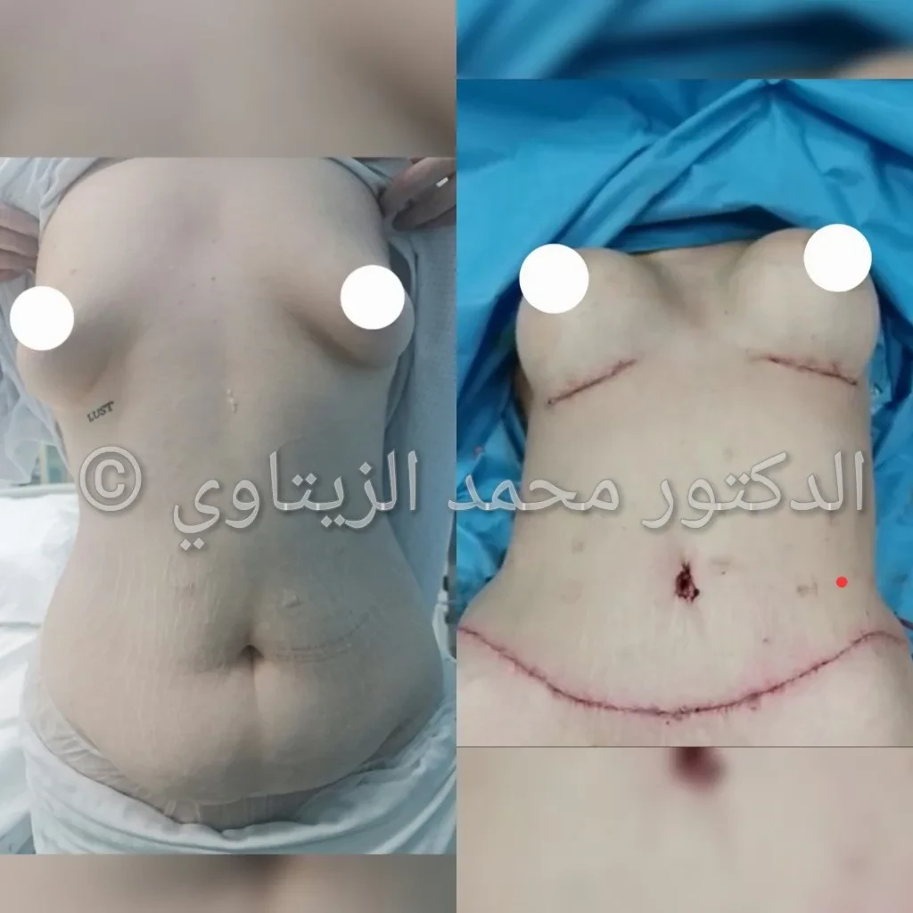 صورة قبل وبعد عملية شد البطن مع تكبير الصدر بحشوات السيليكون في الأردن: بطن مسطح وخصر منحوت وصدر متناسق — مركز الدكتور محمد عبد الوهاب الزيتاوي